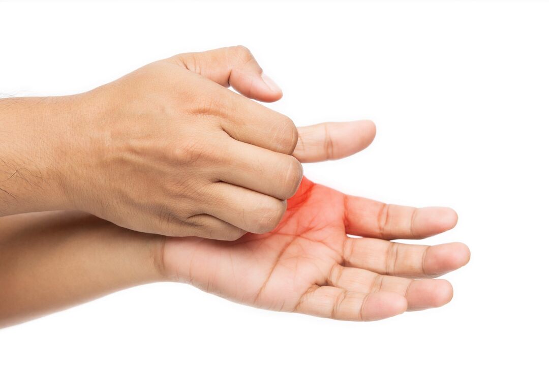 Juckreiz mit dem Pilz und seiner Behandlung mit Demyxil -Creme