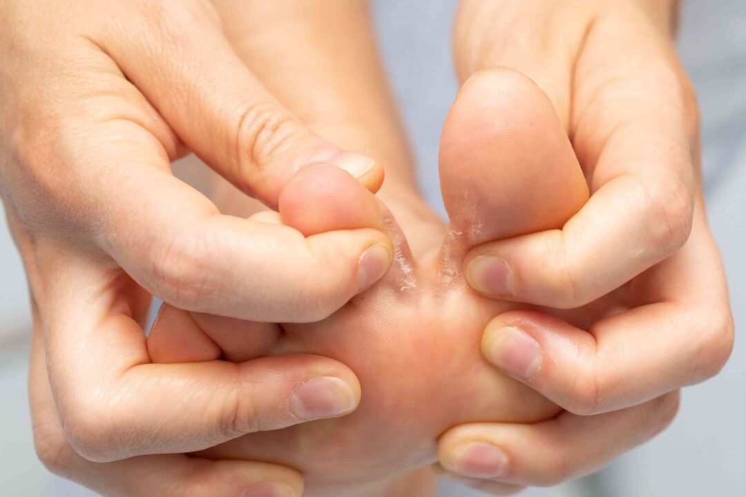 Pilz zwischen den Fingern und seiner Behandlung mit Demyxil -Creme
