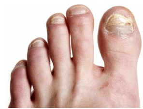 Nagelpilz